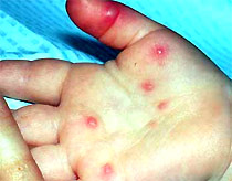 Bệnh tay- chân-miệng đang lan rộng, diễn biến phức tạp